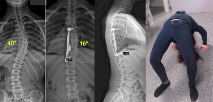 Deformity Implant Mfg ApiFix Closes 2nd Round of Funding
