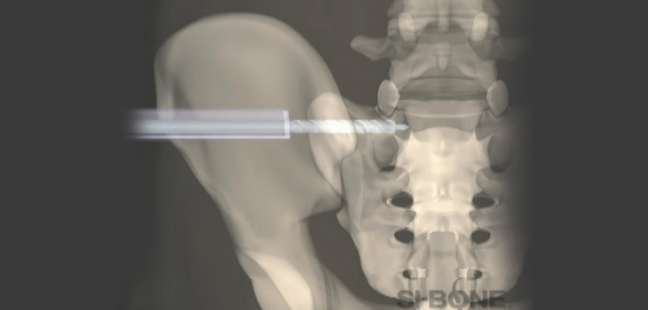 SI-BONE Receives Additional Clearance for iFuse System