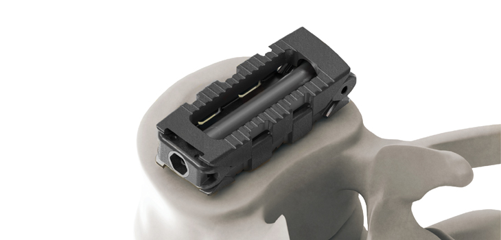 FDA Clears Life Spine’s Expandable Spacer System