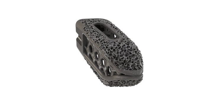 NuVasive Launches TLIF Porous Titanium Spine Implant