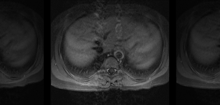 Are Gadolinium Enhanced MRI’s Unreliable?