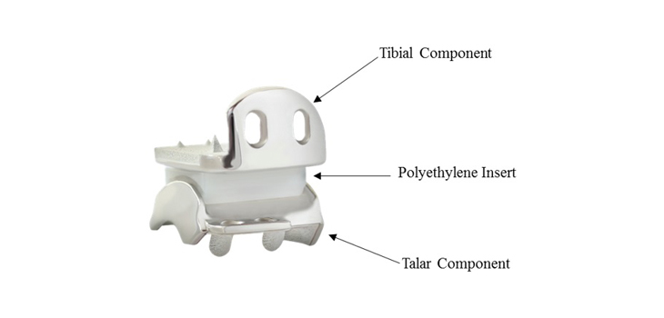 Hintermann Ankle Replacement Receives Rare FDA Approval