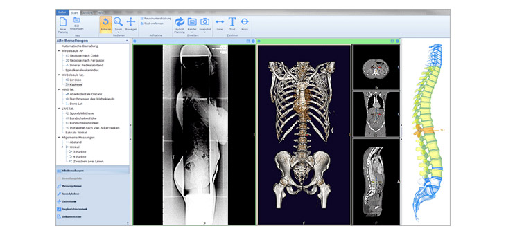 mediCAD Announces Upgrade to mediCAD Spine 3D