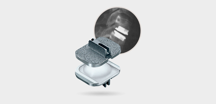 Outpatient Cervical Disc Replacement Outcome Data