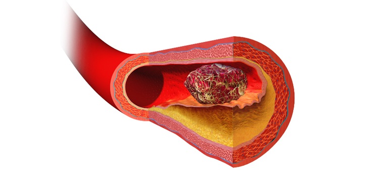 HSS Team Digs Into Likelihood of VTE Before TJA