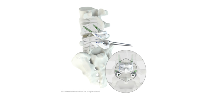 Medacta’s MySpine Wins Best Healthcare Solution Award