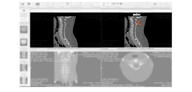 FDA Clears 1st Artificial Intelligence System to Flag CT Images