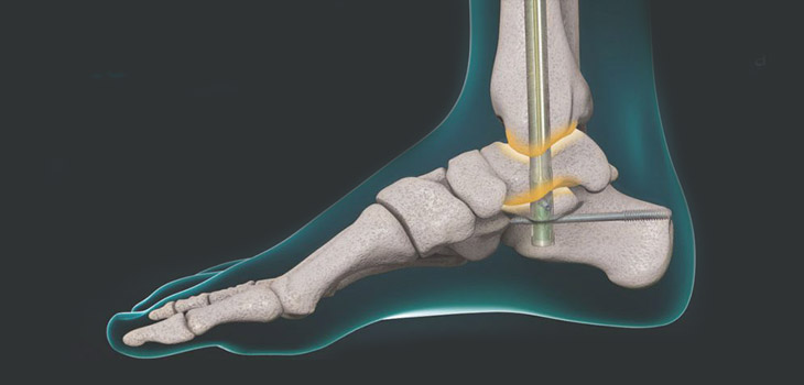 New Data Released for NiTiNOL Implants in TTC Fusion Patients
