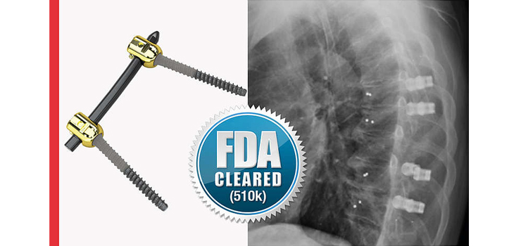 icotec AG’s Pedicle Systems for Spine Tumor Patients Cleared