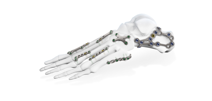 aap Implantate Receives FDA Clearance for 12 Foot Plates/4 Screws