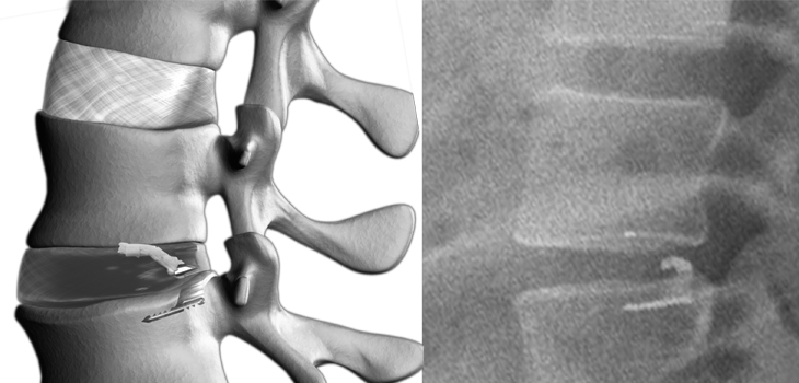 Finally, Annular Closure Is Being Used in the U.S., Again