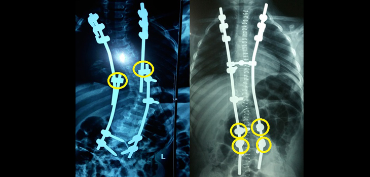 Apex Correction a Superior Deformity Approach?