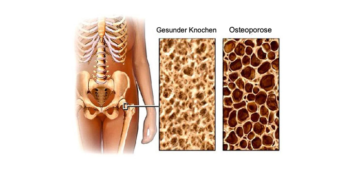 Osteoporosis Surprisingly Undertreated Risk Factor