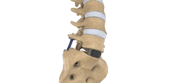 NuVasive Launches Porous Titanium TLIF Implants