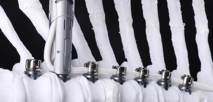 First Spinal Tethering Device for Scoliosis Approved by FDA