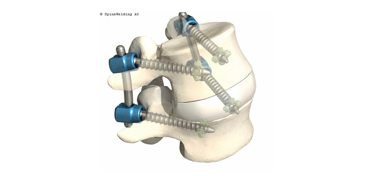 “Bone Welding” Pedicle Screw System Cleared by FDA