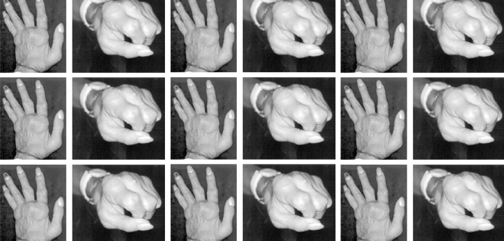 Rheumatoid Arthritis Remission Drug Approved by FDA