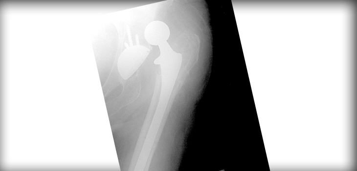 20% of Hip Replacement Patients May Have Spinal Deformity