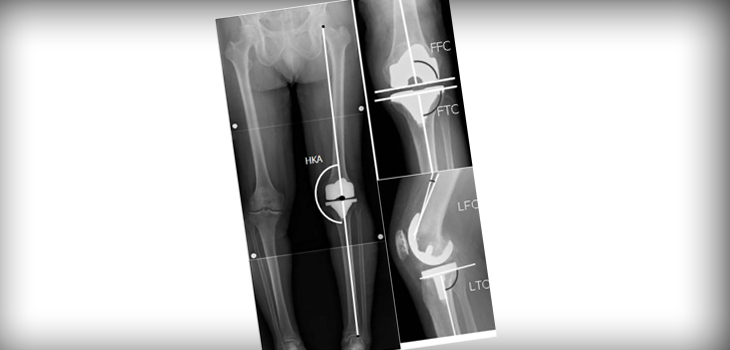 Constraint in Knee Revisions? New Data Says Less Is More