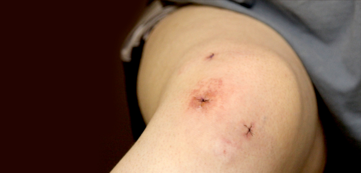 New ACL Technique Improves Pediatric Treatment