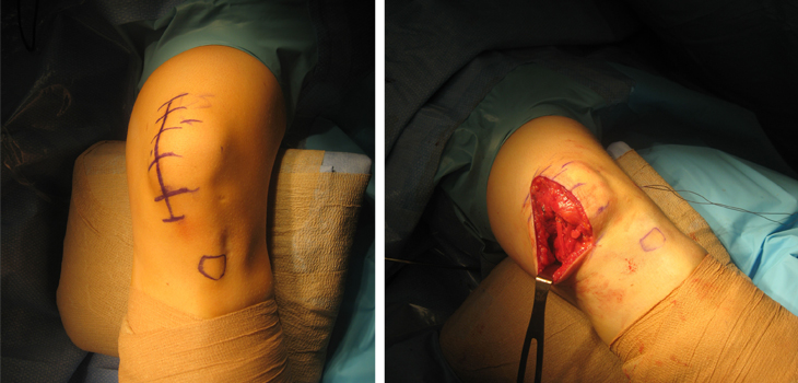 Simultaneous and Concurrent and Bilateral TKA: Why?