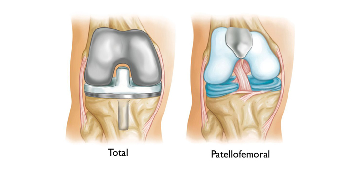 How to Predict Patellofemoral Arthroplasty Failures