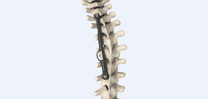 FDA Approves Novel Dynamic Adolescent Scoliosis Correction System