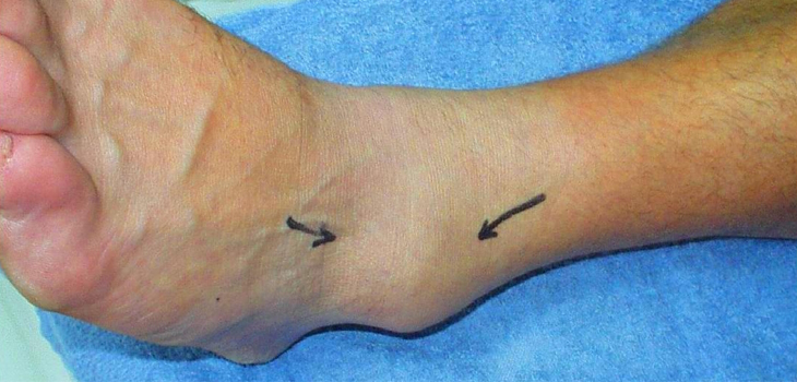 As the Ankle Twists and Turns – Special JAT Edition Released