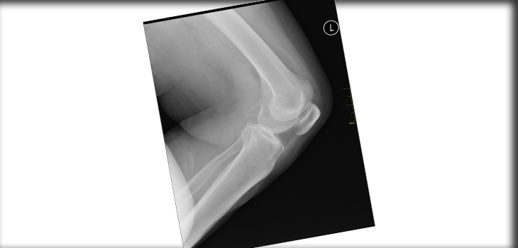 Validated, “Intuitive” Grading System Found Helpful in Knee OA