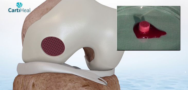 Landmark Cartilage Repair Study Nearing Enrollment