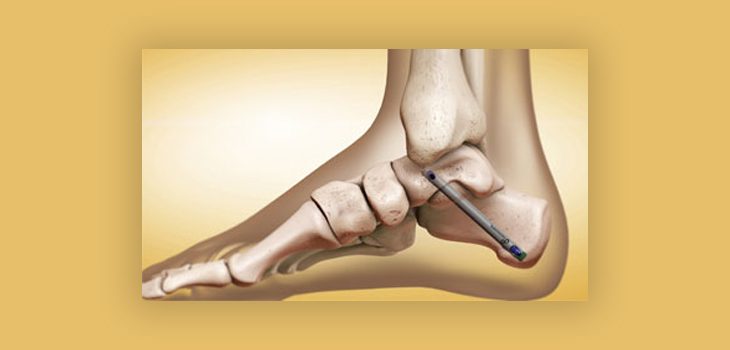 Superelastic Nail for Subtalar Fusion Launched