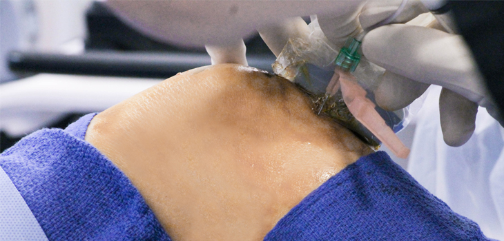 Amniotic Fluid Injections to Treat Painful Knees