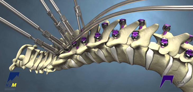 Scoliosis in CP Patients: New Study Examines Implant Hardware