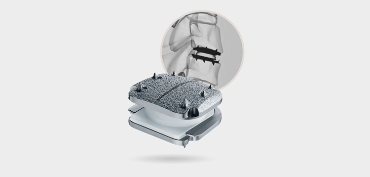 New Data on ProDisc C Vivo