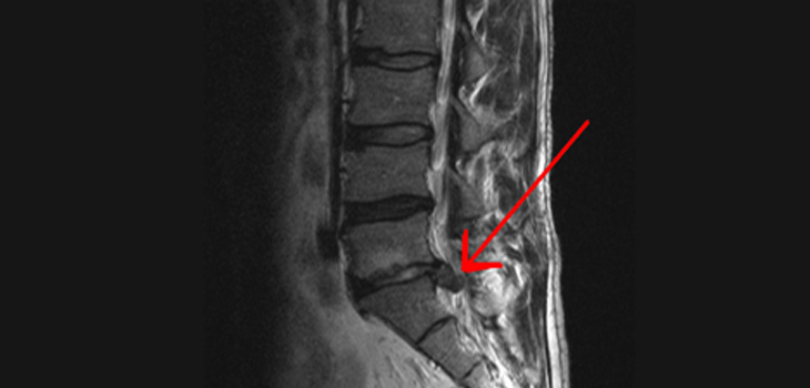 Expanding the Therapeutic Window for Degenerative Disc Disease