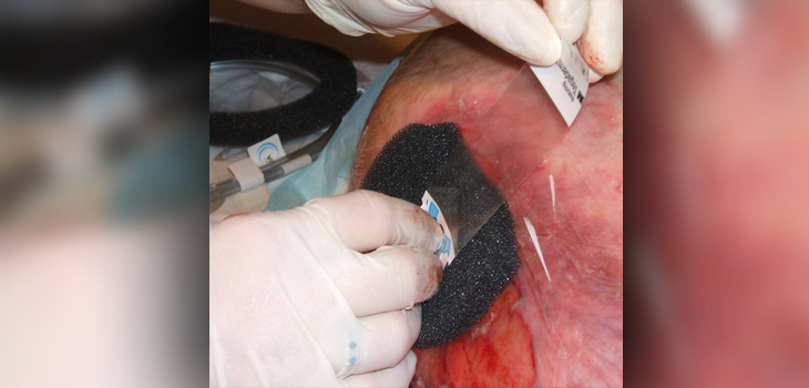 A Modified Wound Closure Approach Cuts Injection Risk
