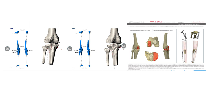 No Robot Required When Using Patient-Specific Instruments?