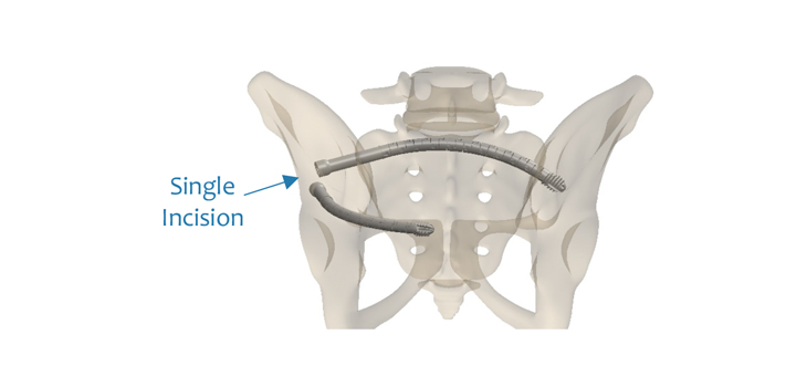 FDA Clears Steerable Rodscrew for Pelvic Repair