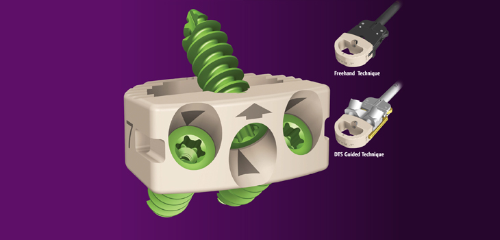 NuVasive CoRoent Cleared for Multiple Contiguous Cervical Levels