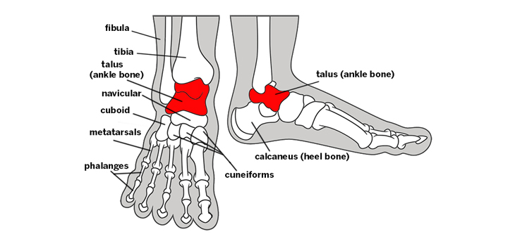Outcome Data for Autologous Osteochondral Transplantation