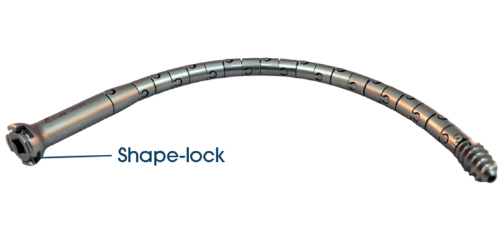 First-in-Man for Novel Pelvic Fracture Rodscrew