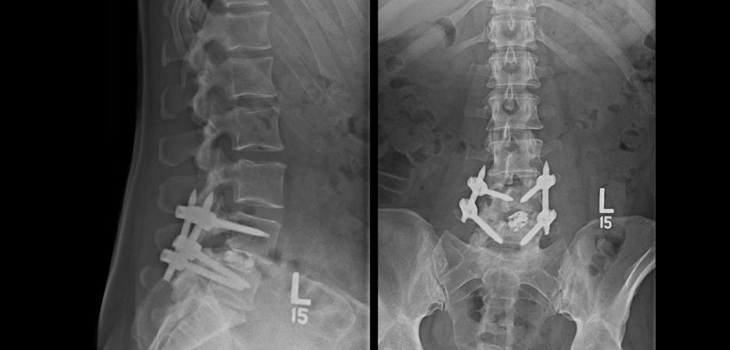 Electrical Stimulation Users >2X Likely to Achieve Vertebral Fusion