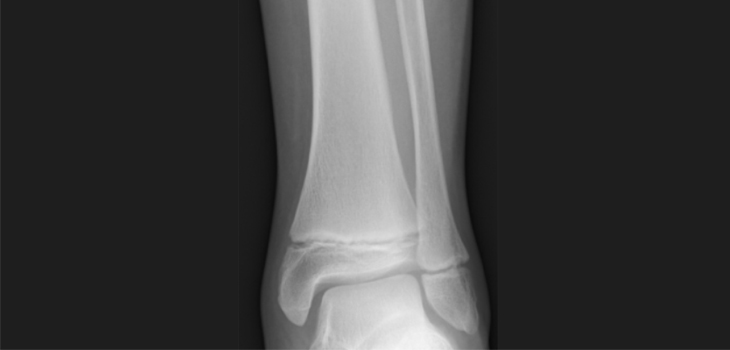 MPFL Reconstruction Also Successful in Pediatric Patients
