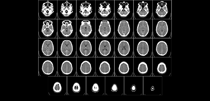 Novel 2-step Algorithm Improves CT Angiography Patient Selection