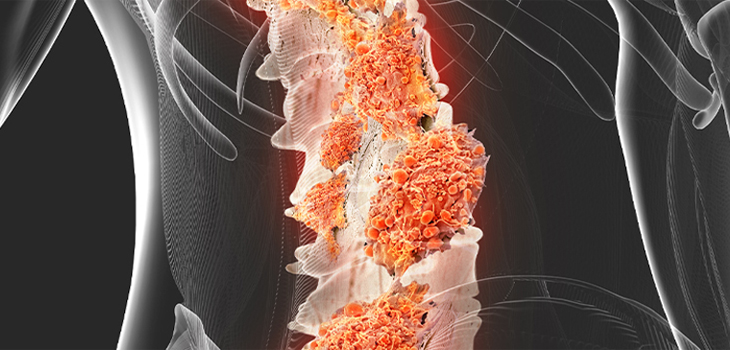 $1 Billion Distribution Deal for Disruptive Back Pain Therapy
