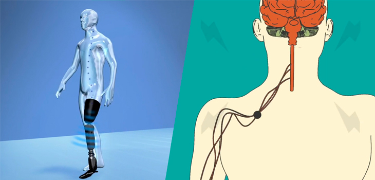 Össur, Alfred Mann Team Up on Mind-Controlled Prosthetics