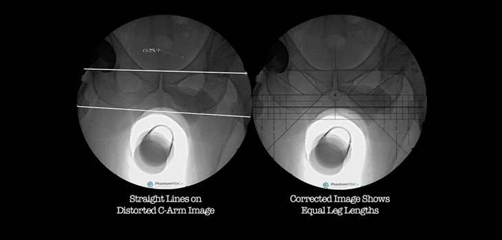 Trauma Indication Added to OrthoGrid’s Fluoroscopic Imaging System