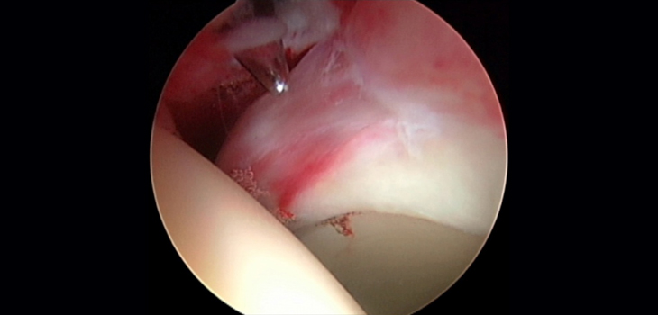 Study Tackles Capsular Incompetency in Revision Hips