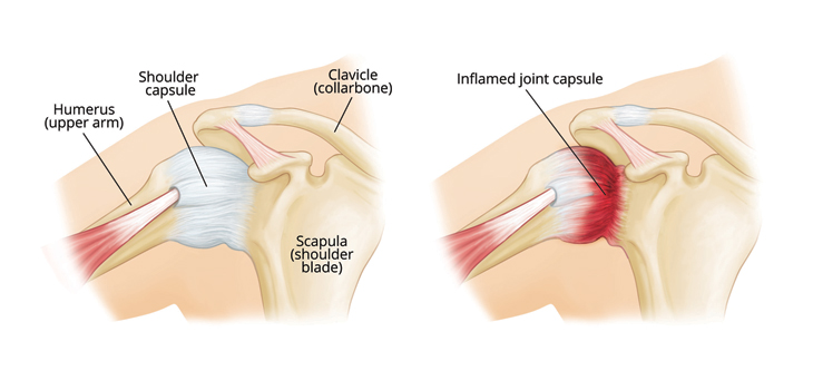 Extended-Release Corticosteroid Study for Shoulder OA Begins