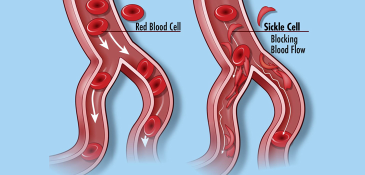 Complication Data for Orthopedic Patients With Sickle Cell